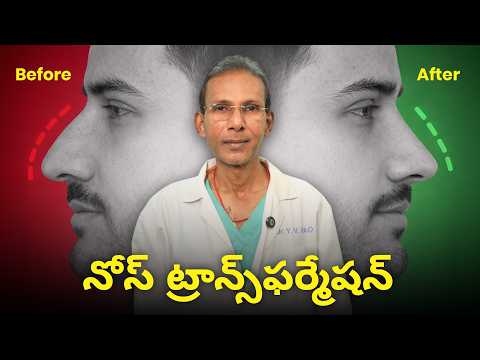 Rhinoplasty Surgery in Hyderabad