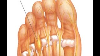 Neuroma de Morton