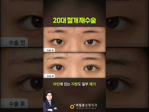 20대 여성의 절개 재수술 · 韩语