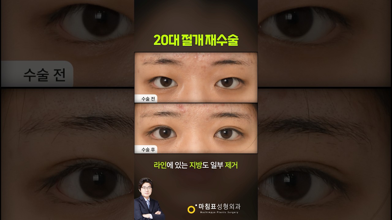20대 여성의 절개 재수술 썸네일 — 마침표성형외과 눈성형 영상