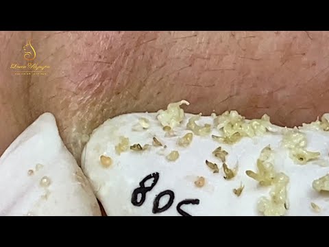 Loan Nguyen Acne Treatment (#119)