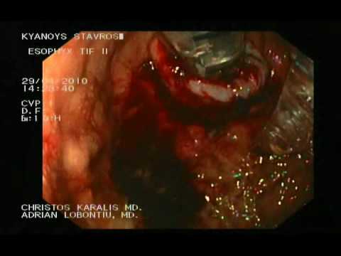 Esophyx - Endoscopic Fundoplication, Part 3.