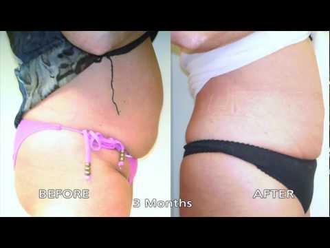 LaserSlim Smart Lipo Full Video