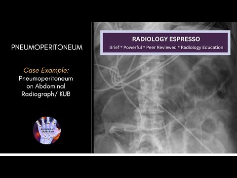 PNEUMOPERITONEUM: Case Example – Pneumoperitoneum on an Abdominal Radiograph (4130).