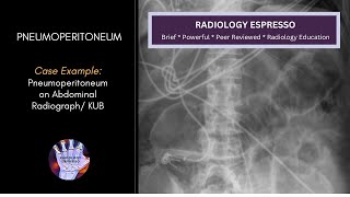 PNEUMOPERITONEUM: Case Example – Pneumoperitoneum on an Abdominal Radiograph (4130).