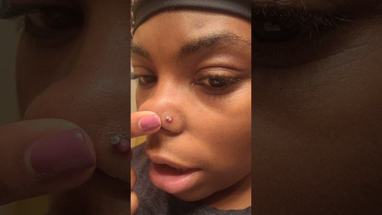 Treating my piercing bump Day 1