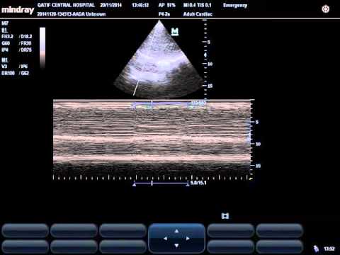 RT diaphragmatic weakness by M mode