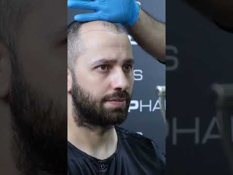 Saç ekim süreçleri nelerdir?