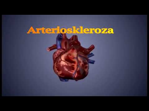 ARTERIOSKLEROZA-Shqip