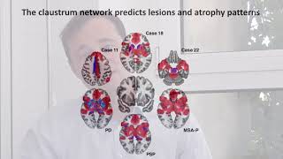Localizing parkinsonism based on focal brain lesions