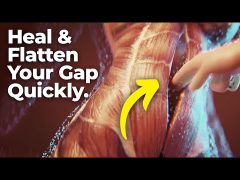 Best Diastasis Recti Exercises To Heal Your Gap Quickly!