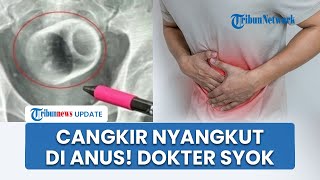 Dokter Syok! Temukan Cangkir Keramik Berukuran 8 Cm Tersangkut di Anus Pasien, Jalani Operasi 2 Jam