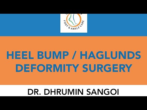 Heel bump or Haglunds bump !!! Patient Testimonial