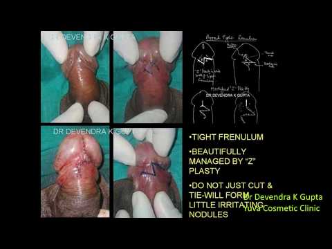 Biji rami untuk potensi laki-laki Bantuan kacang dengan impotensi
