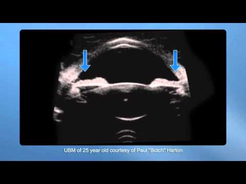 Goldberg UBM file in motion during accommodation - Supplementary video: 25983