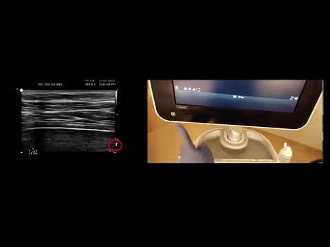 Diaphragm ultrasound