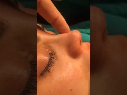 Op. Dr. Cem Karas ile Rhinoplasty,  öncesi ve sonrası...