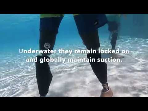 Bilateral Above Knee Custom Direct Skin Fit Suction Sockets