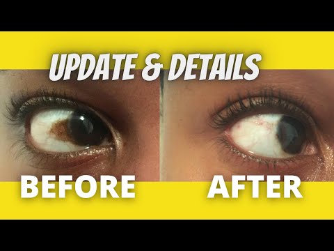 Update - How to get rid of brown spot on eye...