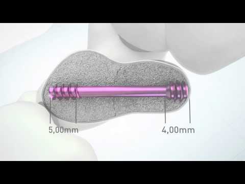 HBS 2 Headless bone screw von KLS Martin