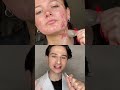 Pimple Patch Secret Dermreacts Acne Skincare