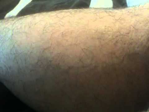 Involuntary calf contractions 5 hours after marathon