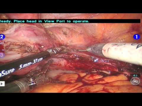 Robotic Surgery for Ovarian Cancer and Endometrial Cancer Part 2