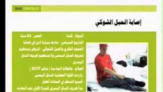 Stem Cells - Spinal Cord Injury (3 cases) - Arabic