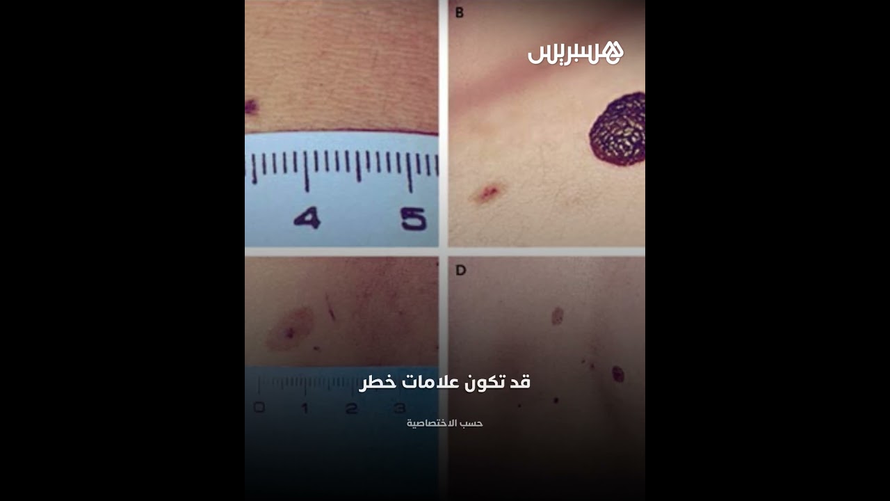 علامات تحذيرية لـ"شامات مشبوهة" قد تكون مؤشرا مبكرا على وجود سرطان الجلد thumbnail