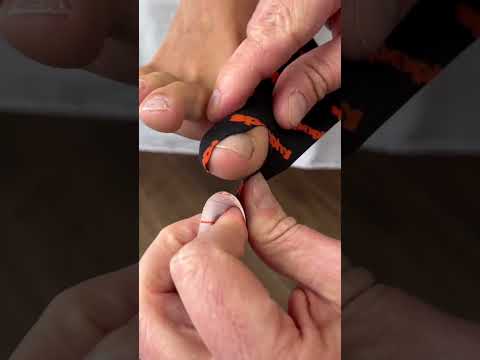 Form following function - the most effective way how to fix the Hallux Valgus