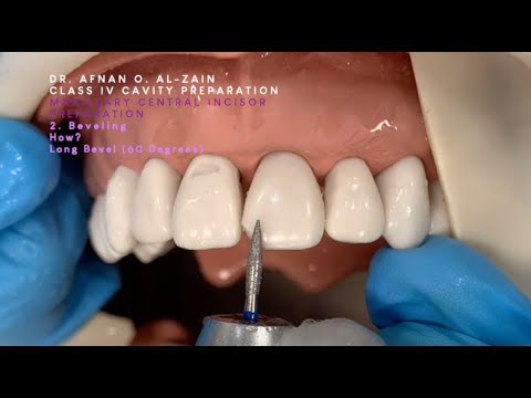 Class IV preparation and beveling – Maxillary central incisor (#21) - Arabic عربي