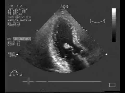 Spontaneous Rupture Of A Papillary Muscle