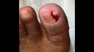 Ep_8156 Ingrown toenail removal 👣 This wound is caused by gauze 😄 (clip from Thailand)