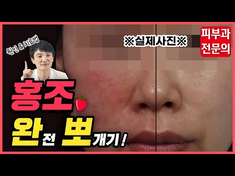 안면홍조 원인과 치료방법? 얼굴 붉어지는 이유 알고계신가요?