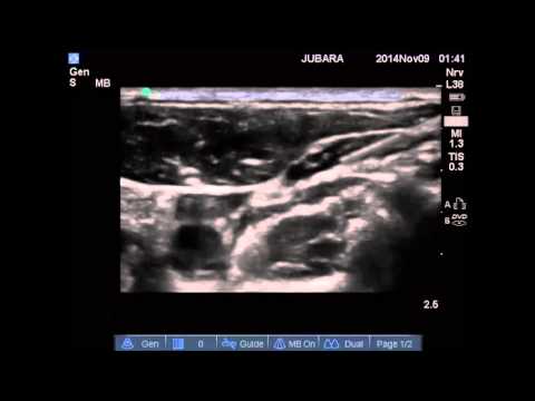 INTERMEDIATE CERVICAL +SUPERFICIAL CERVICAL PLEXUS BLOCK