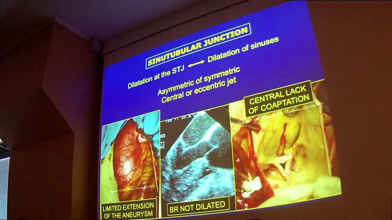 Corso ECM San Gaudenzio Novara - Trattamento della patologia aneurismatica aortica