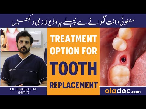 Missing Teeth Solution - Dant Tutne Ka Ilaj - Dental Implants - Best Option For Tooth Replacement