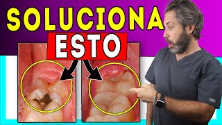 🚩Encía 𝐈𝐍𝐅𝐋𝐀𝐌𝐀𝐃𝐀 Muela del Juicio -💊Tratamiento de 𝙋𝙀𝙍𝙄𝘾𝙊𝙍𝙊𝙉𝘼𝙍𝙄𝙏𝙄𝙎  del tercer molar (𝗦𝗨𝗣𝗘𝗥𝗖𝗹𝗮𝗿𝗼 👌)