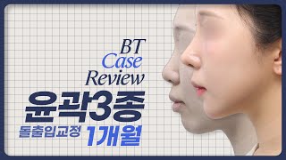 돌출입교정, 케이스 리뷰 ㅣ비티성형외과