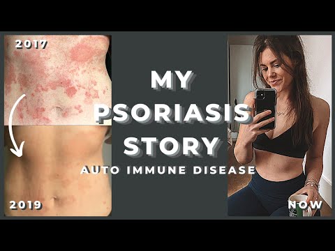 Psoriasis - How I Deal With and Manage Autoimmune Disease (Diet, Treatment, Body Confidence)