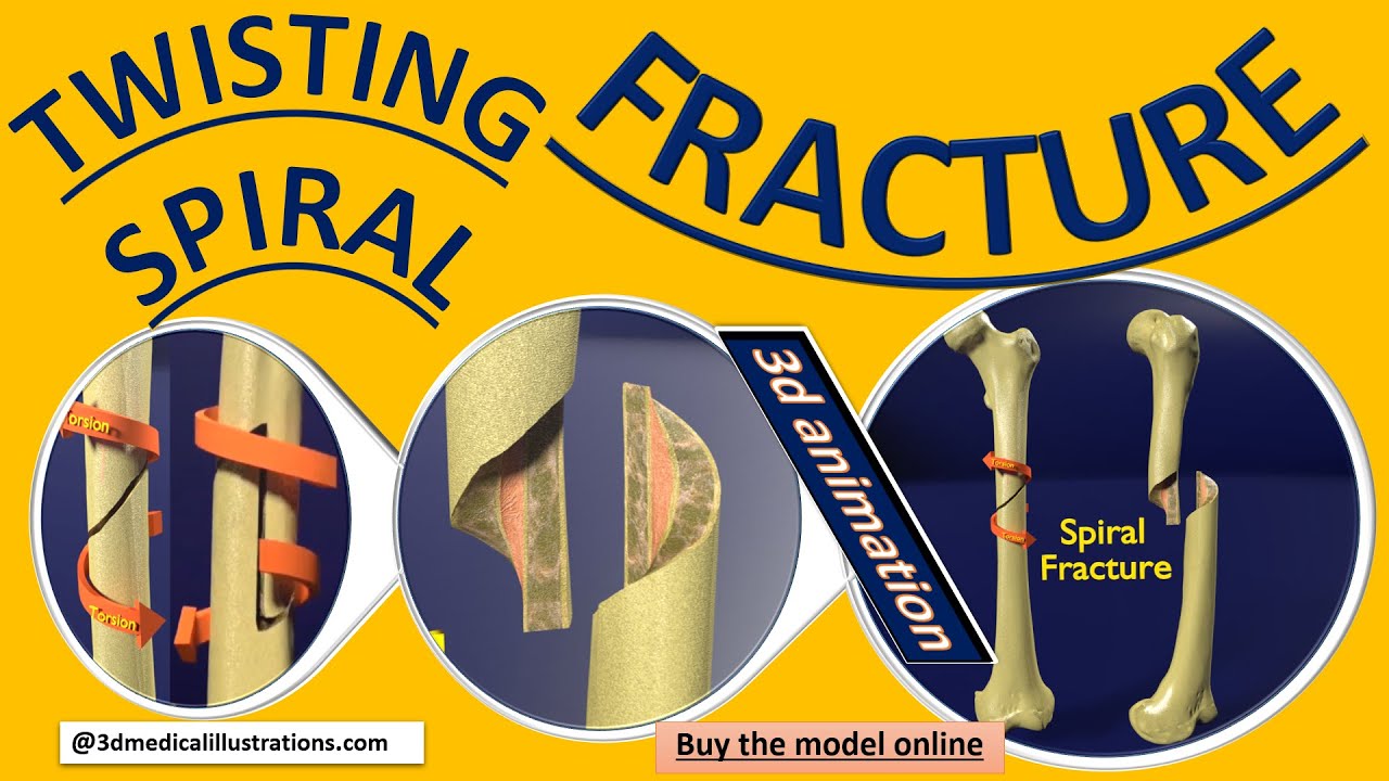 Spiral Fracture skeleton labelled femur 3D Model