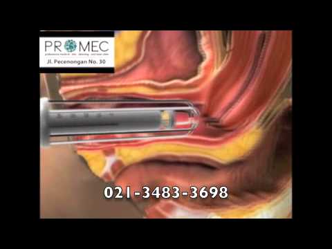 IntimaLase Treatment