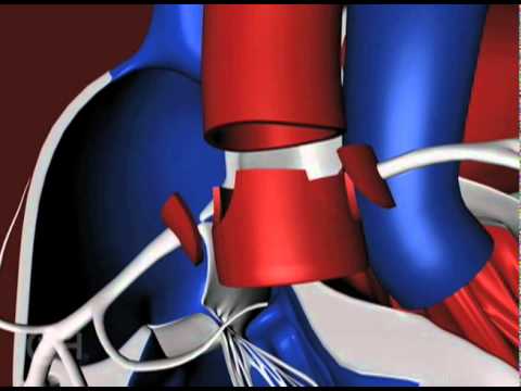 The Arterial Switch Operation to Treat Transposition of the Great Arteries (TGA) - CHOP