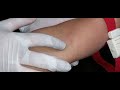 How To Identify Difficult Vein For Blood Collection