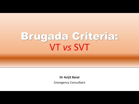 Brugada criteria:  How to differentiate VT from SVT