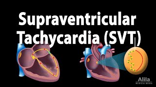 Supraventricular Tachycardia (SVT), Animation