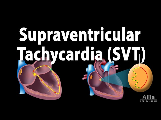 Video Aussprache von atrial tachycardia in Englisch