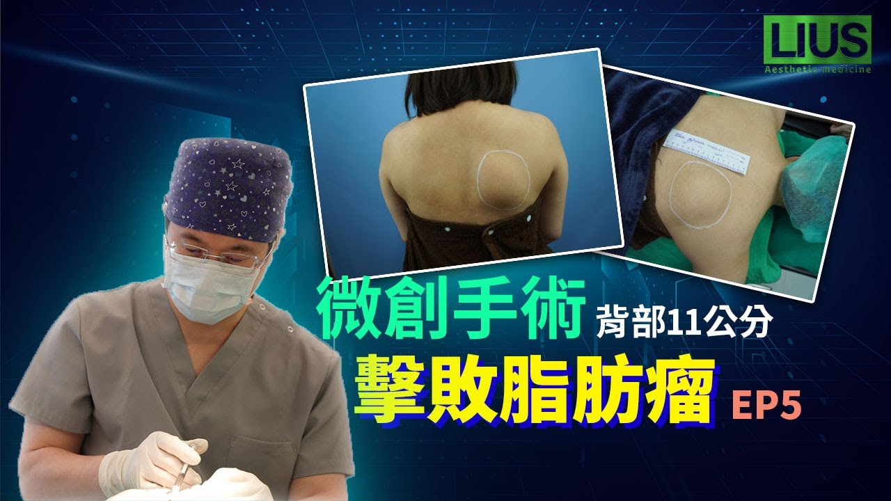 11公分背部脂肪瘤僅需4.5公分切口