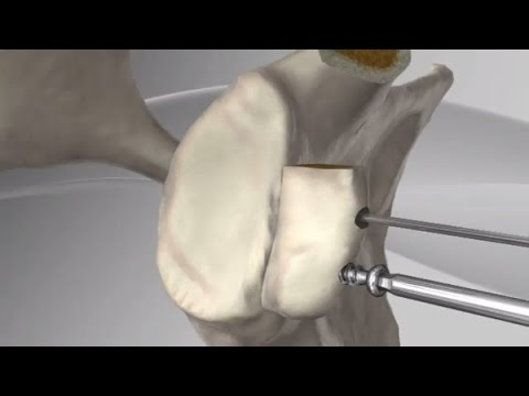 Latarjet for Instability