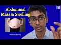 Abdominal Mass Swelling Massive Ovarian Cysts Antai Hospitals